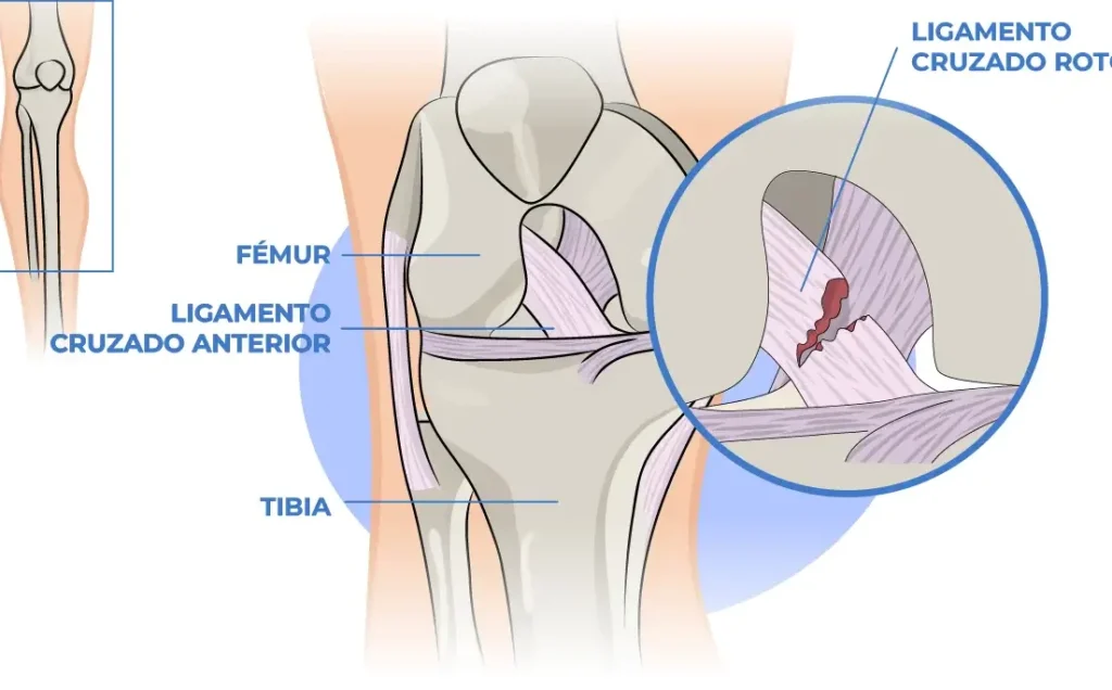 Qué ejercicio puedo hacer si tengo esguince: ejercicios recomendados